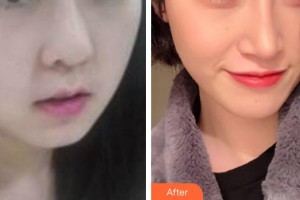 保定藍山醫(yī)療美容醫(yī)院王儉整形價格表附埋線提升案例展示