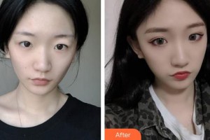 保定市第二醫(yī)院美容科董敏整形價格表附埋線提升例展示