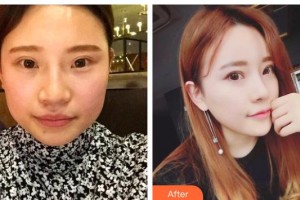 保定世紀協(xié)和醫(yī)院整形美容中心周軍臣整形價格表附熱拉提案例展示