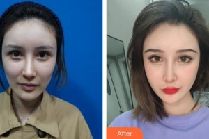 保定世紀協(xié)和醫(yī)院整形美容中心崔鵬程整形價格表附埋線提升案例展示