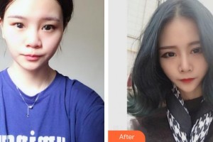 保定珍潤(rùn)醫(yī)療美容門診部王保生整形價(jià)格表附鼻部綜合案例展示