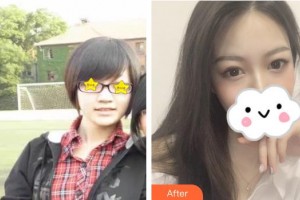 保定市第五醫(yī)院美容整形科劉根立整形價(jià)格表附鼻部綜合案例展示