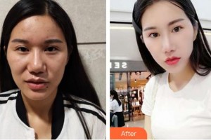 保定市第五醫(yī)院美容整形科單敬依整形價格表附鼻部綜合案例展示