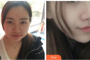 保定杏林中醫(yī)醫(yī)院整形外科從相文整形價格表附耳軟骨復(fù)合隆鼻案例展示