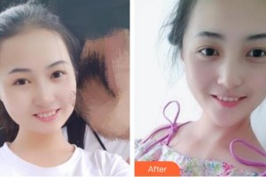 保定華美整形美容醫(yī)院高義豆整形價(jià)格表附冷光美白案例展示