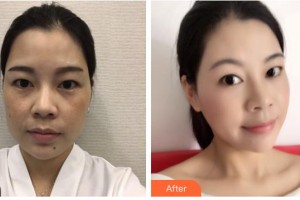 保定藍(lán)山醫(yī)療美容醫(yī)院任莉整形價格表附激光美膚激光案例展示