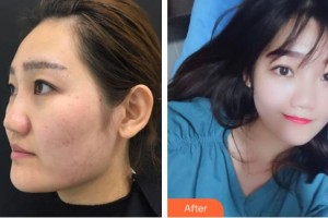 保定世紀協(xié)和醫(yī)院整形美容中心楊德發(fā)整形價格表附熱拉提案例展示