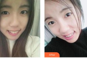 保定藍山醫(yī)療美容醫(yī)院盧闖整形價格表附金屬托槽矯正案例展示