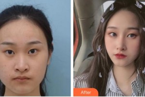 保定普濟醫(yī)療美容診所張杰整形價格表附眼部綜合案例展示