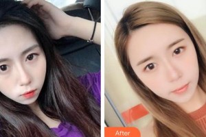 保定葉美思醫(yī)療美容診所劉雙立整形價格表附自體脂肪豐面頰案例展示