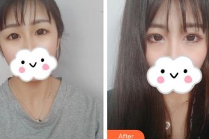 保定藍山醫(yī)療美容醫(yī)院周瑞芳整形價格表附眼部綜合案例展示