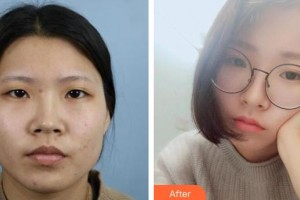 保定藍山醫(yī)療美容醫(yī)院尹延喜整形價格表附切開雙眼皮案例展示