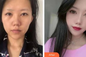 保定新視眼科醫(yī)院馮學峰整形價格表附眼部綜合案例展示