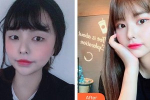 保定新視眼科醫(yī)院武蘊琴整形價格表附眼部綜合案例展示