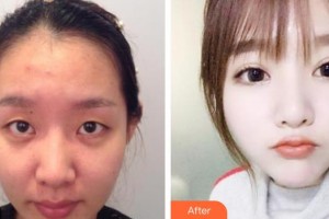 保定新視眼科醫(yī)院接英整形價格表附眼部綜合案例展示