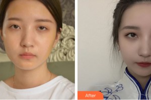 中山愛思特美容醫(yī)院　陳子瑾整形價格表附自體脂肪填充案例展示