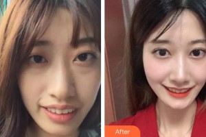 中山小欖人民醫(yī)院整形美容中心王夫平整形價(jià)格表附牙齒矯正案例展示