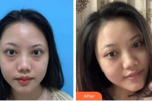 保定新視眼科醫(yī)院李月平整形價格表附內(nèi)切祛眼袋案例展示