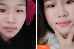 保定悅美醫(yī)療美容門診部整形價格表附埋線雙眼皮案例展示