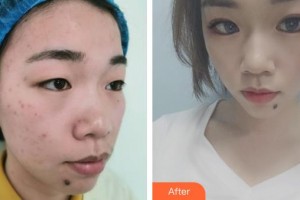 保定藍山醫(yī)療美容醫(yī)院于超整形價格表附定點雙眼皮案例展示