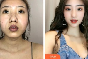 保定藍山醫(yī)療美容醫(yī)院張揚整形價格表附埋線提升案例展示