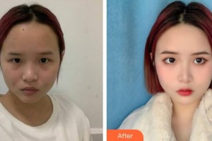 張家口市第四醫(yī)院整形美容科榮美玉整形價格表附激光祛斑案例展示