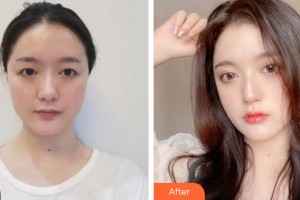 哈爾濱伊美爾光譜醫(yī)療美容門診部郝鐵英整形價格表附眼部手術(shù)案例展示