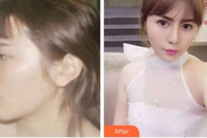 張家口維多利亞醫(yī)療美容醫(yī)院邱榮強整形價格表附鼻部綜合案例展示