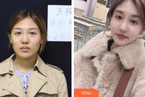 張家口維多利亞醫(yī)療美容醫(yī)院韓楚整形價格表附埋線提升案例展示