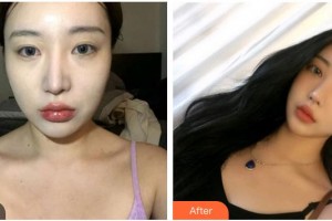 承德玥萊美醫(yī)療美容醫(yī)院孫喜平整形價格表附眼部綜合案例展示