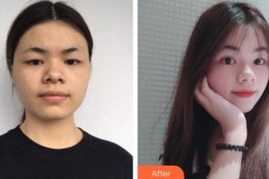 承德愛(ài)爾眼科醫(yī)院宋萬(wàn)卿整形價(jià)格表附眼部綜合案例展示