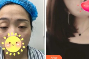 承德美天醫(yī)療美容醫(yī)院郭東超整形價格表附上瞼提肌案例展示