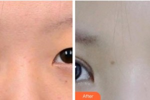 承德名媛醫(yī)療美容門(mén)診部崔春曉整形價(jià)格表附眼部綜合案例展示