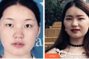 承德醫(yī)學(xué)院附屬醫(yī)院燒傷整形科耿琪瑛整形價(jià)格表附切開(kāi)雙眼皮案例展示