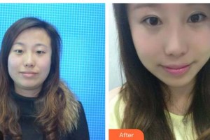 承德愛(ài)爾眼科醫(yī)院孟麗梅整形價(jià)格表附眼部綜合案例展示