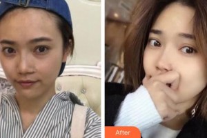 承德玥萊美醫(yī)療美容醫(yī)院楊鵬整形價(jià)格表附切開(kāi)雙眼皮案例展示