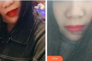 承德玥萊美醫(yī)療美容醫(yī)院韓永剛中心院長(zhǎng)整形價(jià)格表附超聲波潔牙案例展示