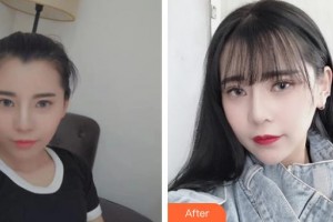 滄州瑞美醫(yī)療美容門(mén)診部胡勁松整形價(jià)格表附肋軟骨隆鼻案例展示