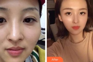 滄州華美醫(yī)療美容醫(yī)院陳遠琨整形價格表附鼻部綜合案例展示