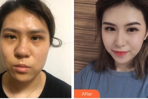 滄州靜港醫(yī)療美容診所金泰民整形價(jià)格表附鼻部綜合案例展示