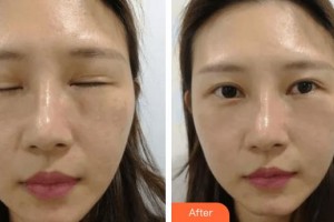 滄州眼科醫(yī)院李月芝整形價(jià)格表附眼部綜合案例展示