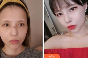 滄州華美醫(yī)療美容醫(yī)院白偉楓院長(zhǎng)整形價(jià)格表附切開雙眼皮案例展示