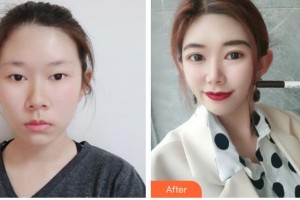 滄州華美醫(yī)療美容醫(yī)院張超院長(zhǎng)整形價(jià)格表附埋線雙眼皮案例展示