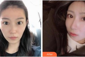 滄州眼科醫(yī)院路露整形價(jià)格表附眼部綜合案例展示