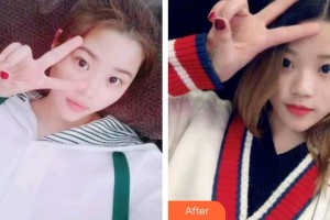 廊坊凱潤(rùn)婷（原悅美）醫(yī)療美容門診部張誠(chéng)整形價(jià)格表附切開雙眼皮案例展示