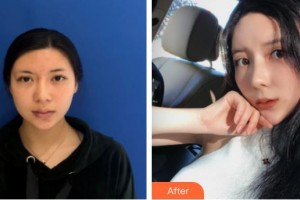 廊坊凱潤(rùn)婷（原悅美）醫(yī)療美容門診部郭佳穎整形價(jià)格表附熱瑪吉案例展示