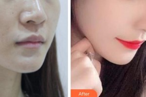 廊坊瑞美慧醫(yī)療美容診所韓增鵬整形價(jià)格表附鼻部綜合案例展示