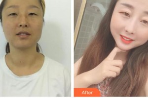 廊坊頤美佳醫(yī)療美容醫(yī)院蔣海越整形價(jià)格表附白瓷娃娃案例展示