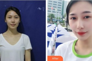 衡水天宏醫(yī)療美容醫(yī)院張莉整形價(jià)格表附玻尿酸精華導(dǎo)入案例展示