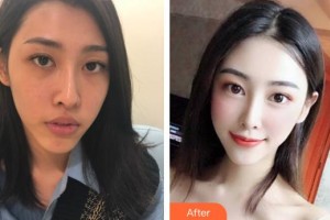 衡水唯美醫(yī)療美容門診部趙燕整形價(jià)格表附鼻部綜合案例展示